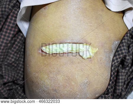 Post Operation Wound Of Injection Abscess With Cotton Gauze Inserted.