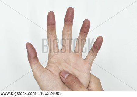 Cyanotic Hands Or Peripheral Cyanosis Or Blue Hands At Southeast Asian, Chinese Young Man