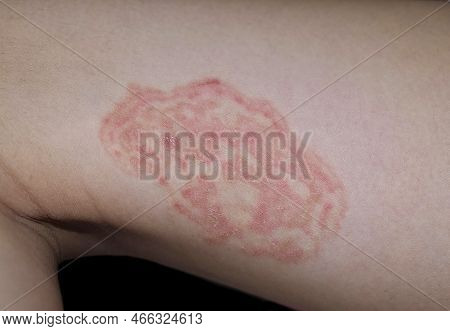 Fungal Infection Called Tinea Corporis In Thigh Of Southeast Asian Child. Ringworm