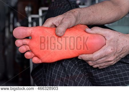 Tingling And Burning Sensation In Foot Of Asian Elder Man With Diabetes. Foot Pain. Sensory Neuropat