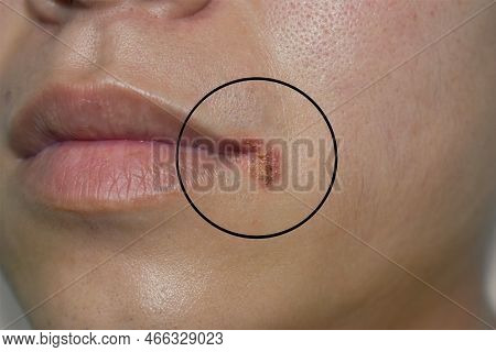 Angular Stomatitis Or Angular Cheilitis Or Perleche In Asian Young Man. Common Inflammatory Conditio