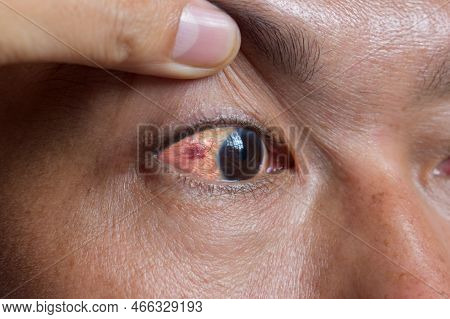 Ocular Larva Migrans Or Dilated Vessels In The Eye Of Southeast Asian Man.