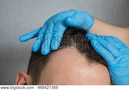 Hands Of Doctor In Rubber Gloves Doing Checkup Of Hair Of Man To Fight Male-pattern Baldness. Patien