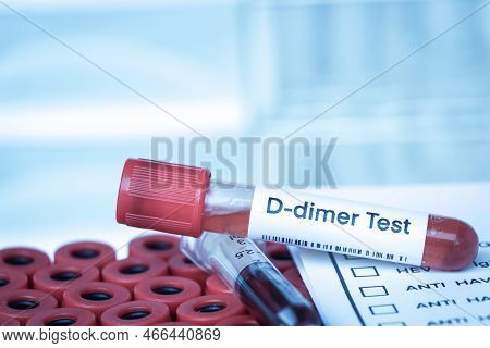 D-dimer Test To Look For Abnormalities From Blood,  Blood Sample To Analyze In The Laboratory, Blood