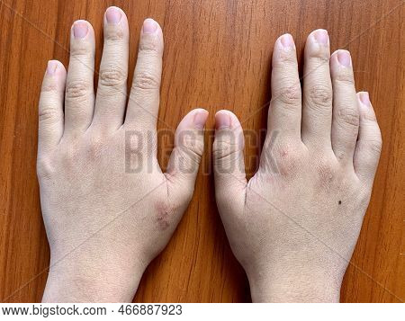 Cyanotic Hands Or Peripheral Cyanosis Or Blue Hands At Southeast Asian, Chinese Man