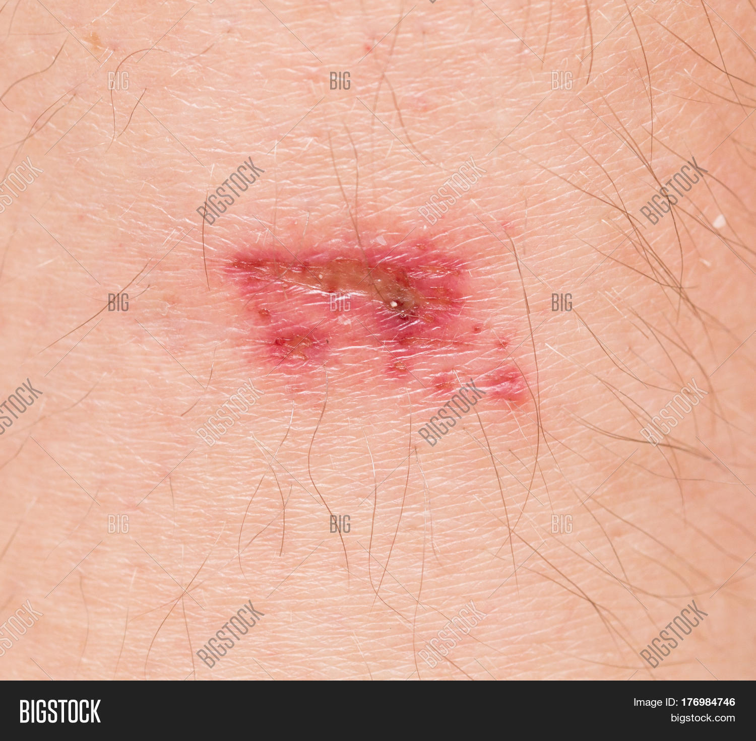 human skin stock photo 169 chaoss 1695911 wound on human skin image photo bigstock human skin stock photo 169 chaoss 1695911 wound on human skin image photo bigstock