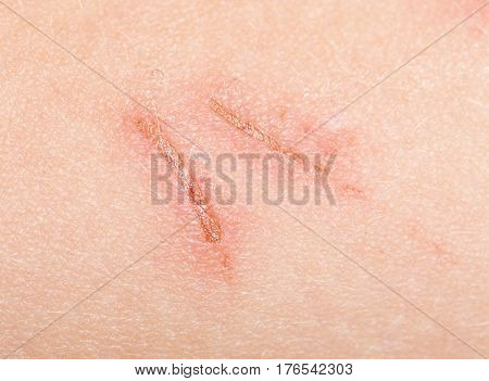 a wound on the skin. close . Professional photo