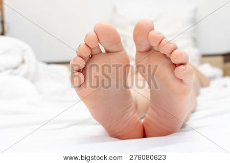 Dry Skin, Plantar Callosity And Flakes On The Child Feet Soles Close Up.