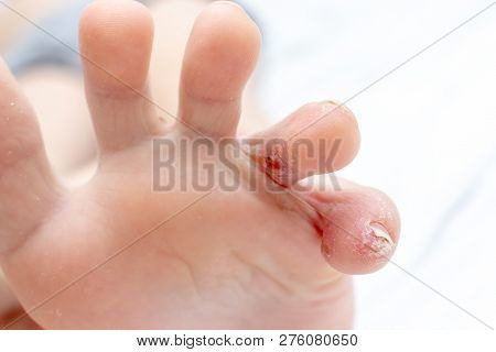 Dyshydrotic Eczema, Atopic Dermatitis Injury, Damage On Foot And Toes Of A Child. Dermatology And Pe