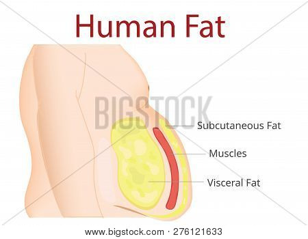 Body Fat, Liposuction, Diet , Surgery, Exercise - Vector