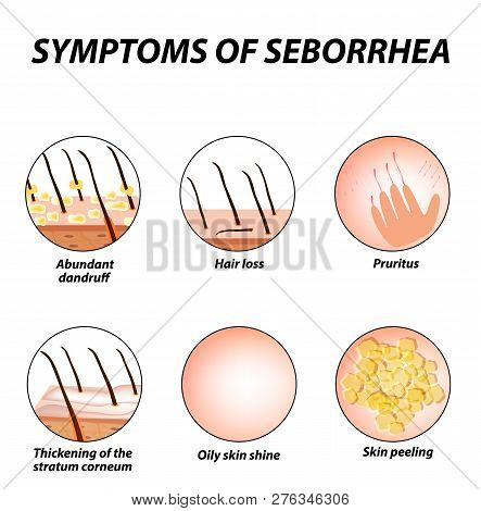Symptoms Of Seborrhea. Seborrhea Skin And Hair. Dandruff, Seborrheic Dermatitis. Baldness, Hair Grow