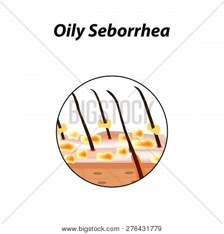 Oily Seborrhea Of Skin And Hair. Dandruff, Seborrheic Dermatitis. Baldness, Hair Growth, Baldness. A