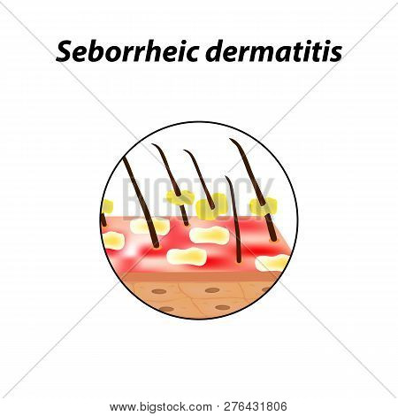 Seborrheic Dermatitis Of The Skin And Hair. Dandruff, Seborrhea. Baldness, Hair Growth, Baldness. An
