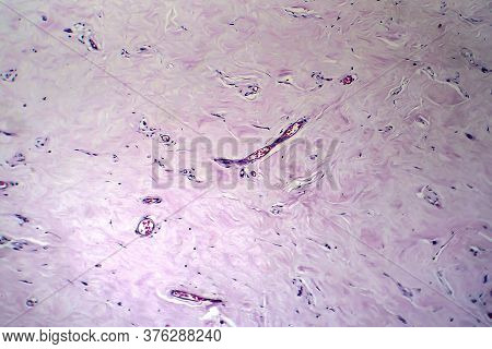 Uterus Adenofibroma, Light Micrograph, Photo Under Microscope. A Rare Benign Tumor Of The Uterus Com