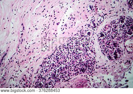 Breast Fibroadenosis, Light Micrograph, Photo Under Microscope. Common Benign Hyperplastic Process I