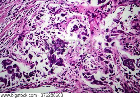 Breast Ductal Carcinoma, Light Micrograph, Photo Under Microscope