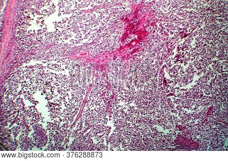 Testicular Seminoma, Light Micrograph, Photo Under Microscope. A Most Common Germ Cell Tumor Of The 