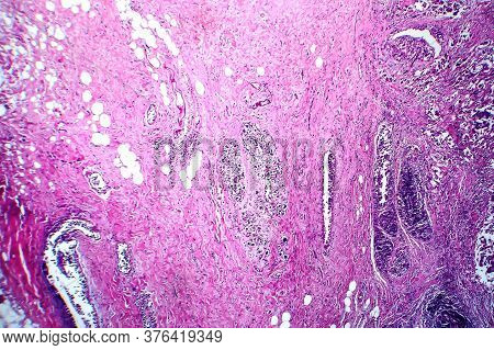 Breast Ductal Carcinoma, Light Micrograph, Photo Under Microscope