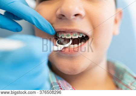 Closeup Of Orthodontist Examining Boy Wearing Braces With Dental Mirror