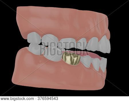 Human Jaw With Gold Tooth, Golden Crown Of A Molar, 3d Render