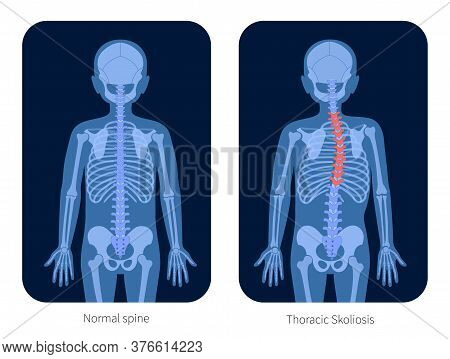 Normal Spine And Thoracic Scoliosis In Boy Body. Xray Flat Vector Illustration. Backbone, Joint And 