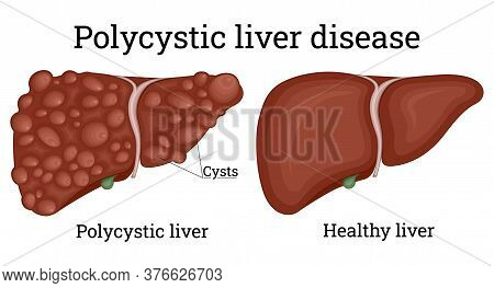 Illustration Of A Healthy Liver And Polycystic Liver
