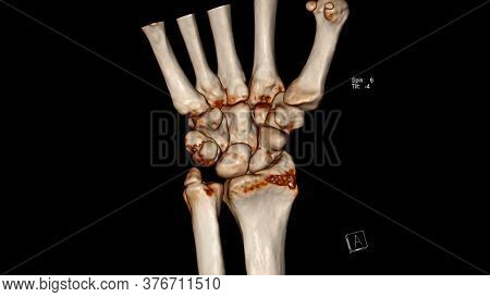 Radiology Examination, Computed Tomography Volume Rendering Examination Of The Wrist Joint ( Ct Vr W