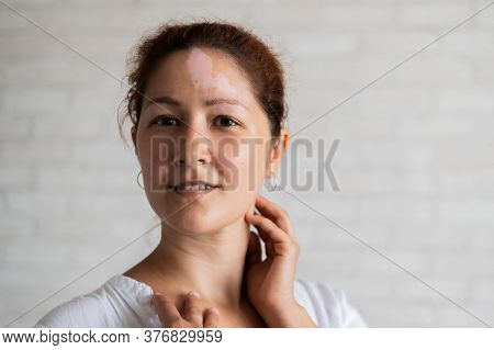 Vitiligo. Portrait Of A Beautiful Smiling Woman With Lack Of Skin Pigmentation On Her Forehead. A Gi