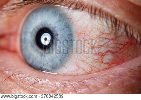 Irritated Male Blue Eye Full With Capillar Net Close-up