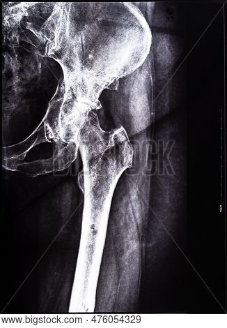 Negative X-ray Of Junction Of Tibia And Pelvis After Healed Of Fracture Of Acetabular Cavity