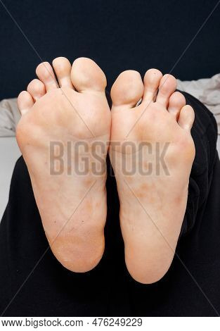 Dyshidrotic Eczema On The Sole Of Female Feet