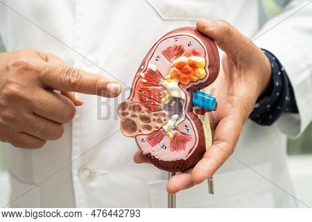 Kidney Disease, Chronic Kidney Disease Ckd, Doctor Hold Model To Study And Treat In Hospital.