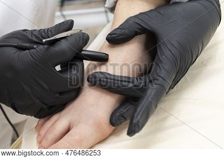 Closeup Process Of Permanent Unwanted Hair Removal On Foot, Toe, Using Electroepilation Device And T