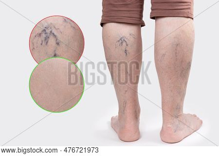 Varicosity. Close Up Side View Of Old Feet Of Woman With Vascular Asterisks. Rear View. Zoomed Area 