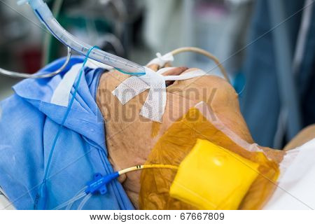 On Endotracheal Tube In Operation Room For Cardiac Surgery