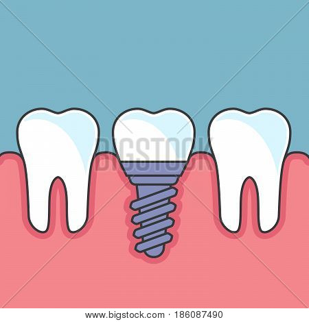 Row of teeth with dental implant - dental prosthetics