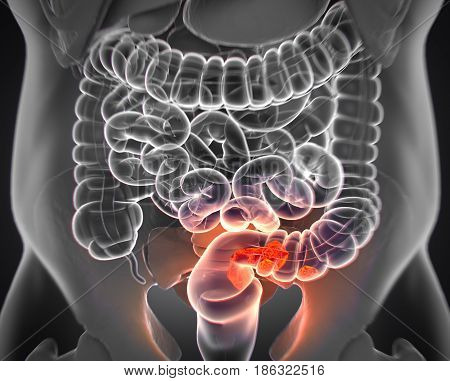 Colorectal Cancer,medical Illustration.3D Illustration