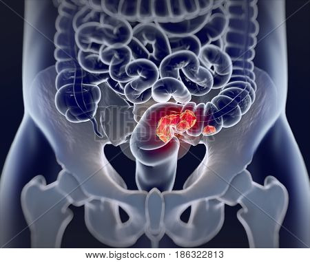 Colorectal Cancer,medical Illustration.3D Illustration