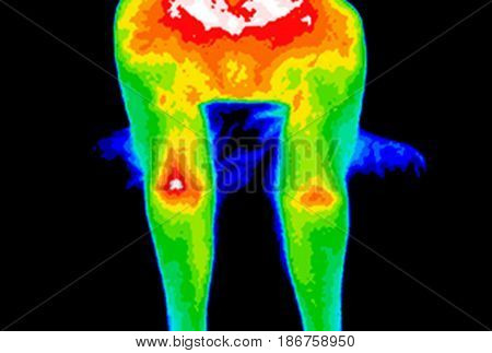 Thermographic image of inner arms showing different temperature in a range of colors from blue showing cold to red showing hot which can indicate joint inflammation.