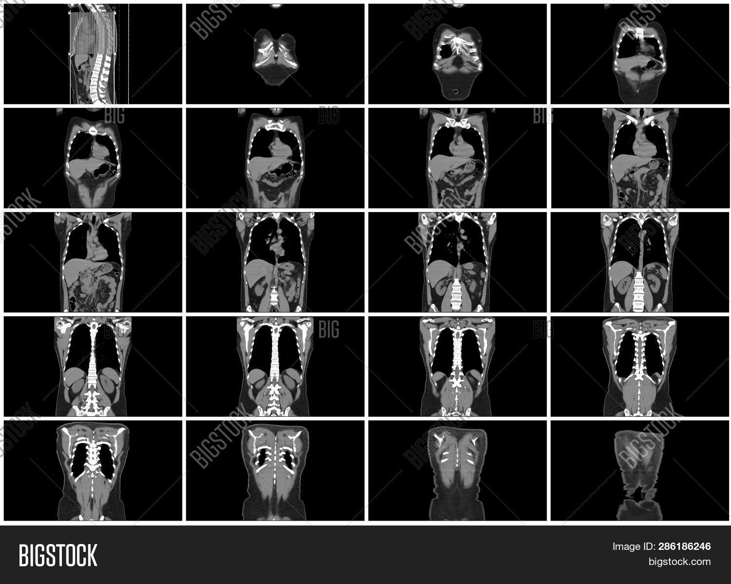 Download high-quality ct scan step set body coronal view images