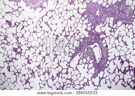 Histopathology Of Pneumonia, Light Micrograph, Photo Under Microscope