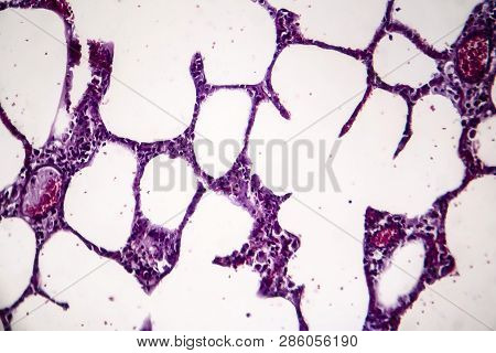 Histopathology Of Pneumonia, Light Micrograph, Photo Under Microscope. Cellulose Aspiration Pneumoni