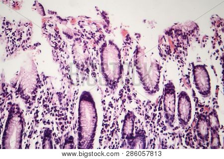 Histopathology Of Chronic Atrophic Gastritis, Light Micrograph, Photo Under Microscope