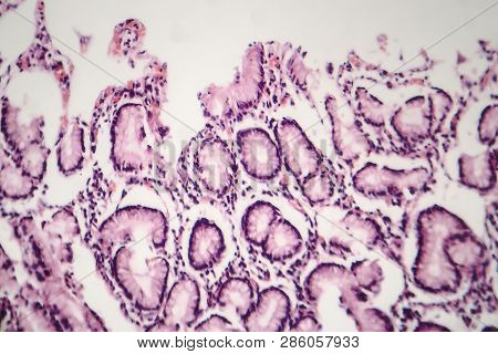 Histopathology Of Chronic Atrophic Gastritis, Light Micrograph, Photo Under Microscope