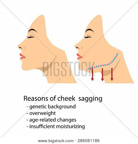 Face Of A Woman Demonstrating Aging Changes In Jaw Angle