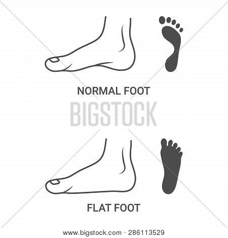 Foot Pathologies, Normal, Flat Foot Isolated On A White Background. Vector Illustration. Orthopedics