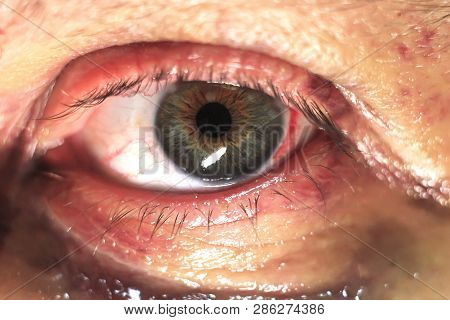 Eye Injury Bruises And Bruises. A Blow To The Eye