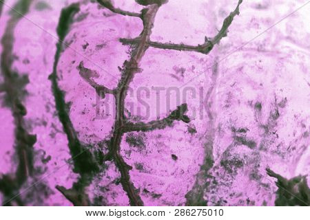Human Squamous Cell Carcinoma. Tissues Affected By Cancer Cells Under A Microscope.