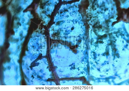 Human Squamous Cell Carcinoma. Tissues Affected By Cancer Cells Under A Microscope.