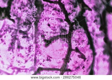 Human Squamous Cell Carcinoma. Tissues Affected By Cancer Cells Under A Microscope.